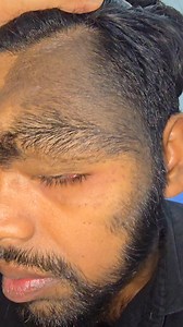 Acquired Hairy Melanocytic Nevus | Dr. Khaled Hasan Milu