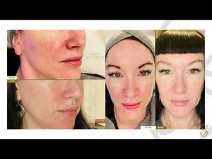 Rosacea/Hyperpigmentation Case Study - BBL/Moxi Laser