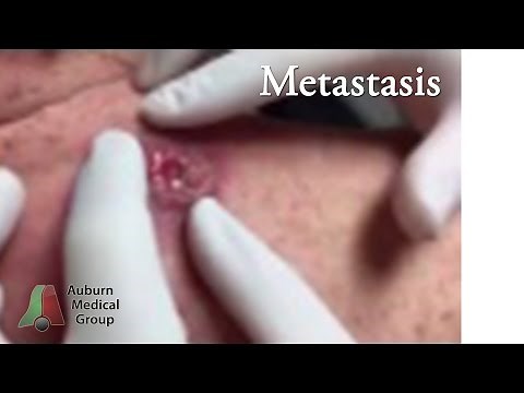 Malignant Melanoma Disguised | Auburn Medical Group