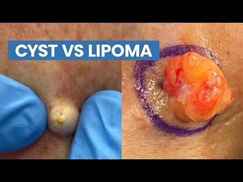 Cyst vs Lipoma (Short Pops Compilation) | CONTOUR DERMATOLOGY