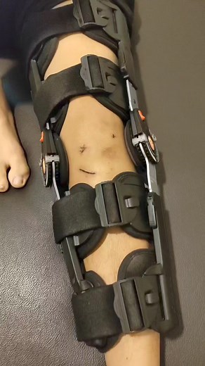 Many different treatment methods can reduce the trauma and surgical scars. These include physical methods: manual therapy, appropriate pressure, taping, cryotherapy, dermabrasion, radiation, laser therapy, pharmacological methods, and surgical techniques. The most effective is a combined therapy. The role of mobilisation, or massage, is to break down the scar tissue and encourage the collagen fibres to realign into a better position, allowing the tissue to function more normally. Learn more abou