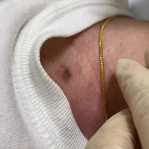 Moles are a common type of skin growth. They often appear as small ,dark brown spots and are caused by pigment cells clusters. Easy to get rid of Moles ,Skin Tags fast and permanently. Call us now 018-4600 290 #thelushclinic #molesremoval #skintagremoval #arcorismontkiara #aesthetickl #aesthethicclinickl #laser #cryotherapy #cryopen | TheLushClinic