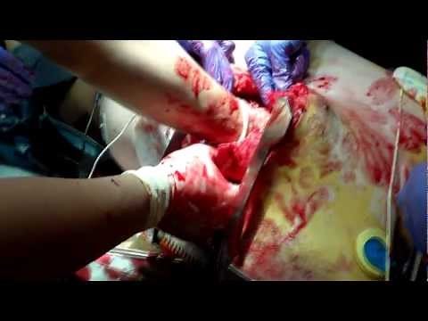 Open Thoracotomy (Viewer Discretion Advised)