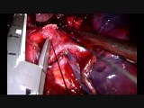 Uniportal Vats Complex Sleeve Bilobectomy With Reconstruction of B1-B2-B3 • Video • MEDtube.net