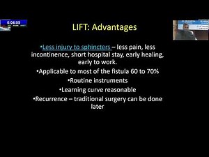 LIFT (Ligation of Intersphincteric Fistula Tract)