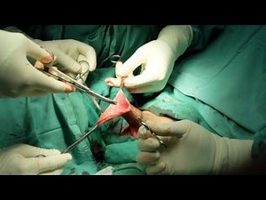 Circumcision | How To