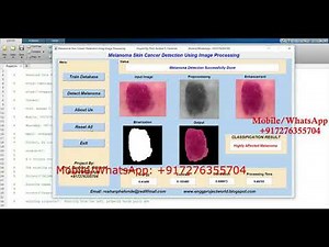 Melanoma Skin Cancer Detection Using Image Processing | With Source Code | Matlab Project Code