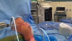 Rotator Cuff Repair & Biceps Tenodesis With Interpositional Synthetic Nanofiber Scaffold Augmentation