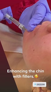  Shape and projection of the chin is essential ❌ Rounded chin...