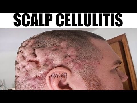 Cellulitis of the Scalp | Extreme Bizarre Medical