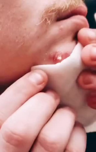 pimples on faces #cravos #blackhead #zit #popper #acne #zits #pimplepop #pimple #popping #asmr #pimples #fyp #live