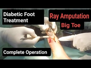 Diabetic Foot | Ray Amputation of Big Toe | Stepwise Procedure | Surgeon Dr Imtiaz Hussain