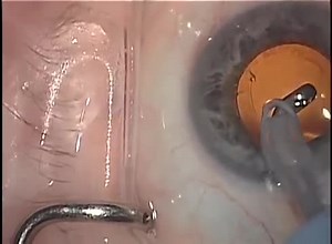 Ab-Interno Canaloplasty: A Comprehensive Approach to MIGS - Eyetube