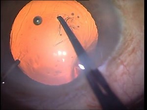 Rhexis for beginners with Utrata forceps Dr.Soosan Jacob, MS, FRCS, DNB #Phaco #Ophthalmic_Surgery | Piece of ophthalmology