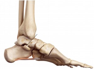 Treating Talar Neck Fractures | Silverman Ankle & Foot
