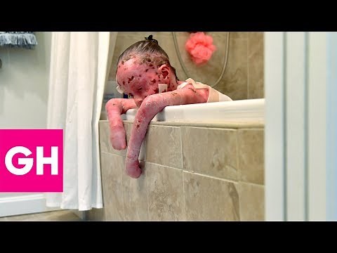The Heartbreaking Reality of Butterfly Babies | GH