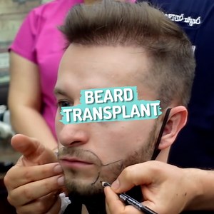 17K views · 56 reactions | This guy documented his beard transplant journey, and the results are so good 倫 | Ultimate | Facebook