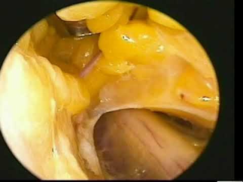 Décompression du nerf ulnaire au coude assistée par endoscopie
