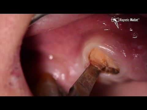 Extraktion Wurzelrest