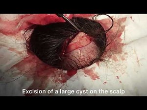 Excision of a large cyst on the scalp