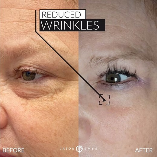 3.5K views · 15 comments | PICTURE PERFECT EYES Sagging under eyes?...