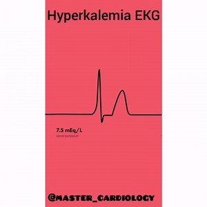 ⭕Hyperkalemia : may be associated with a variety of changes on the electrocardiogram (ECG). Tall peaked T waves with a shortened QT interval are usually the first findings . As the hyperkalemia gets more severe, there is progressive lengthening of the PR interval and QRS duration, the P wave may disappear, and ultimately the QRS widens further to a sine wave pattern. Ventricular standstill with a flat line on the ECG ensues with complete absence of electrical activity. ✔️ Learn more on Hyperkale