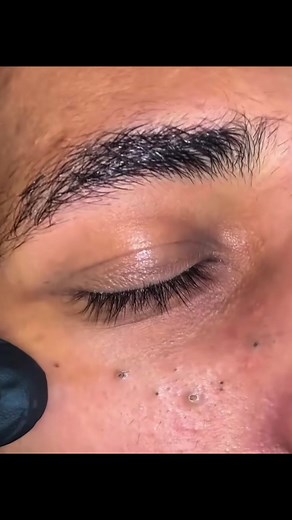 #satisfyingvideos #extraction #pimplepopper #blackhead #viral | extraction ending