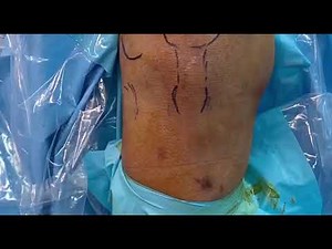 A Modified LaPrade Technique in Posterolateral Corner Reconstruction of the Knee