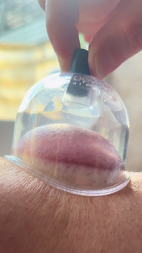 🏆 Cupping therapy decompresses fascia and muscle to improve circulation, reduce stiffness, and support recovery. #Cupping #DrKyleRoss #chiropractor