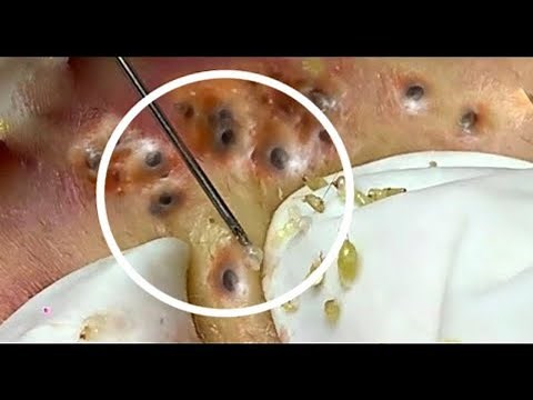 Best Pimples Popping Blackheads ||
