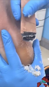 #callousedfeet #podiatry #callusremoval #callousremoval #parmeseanpalms #GroomingRoutine #foryoupage #reelsviralfb #podologia #callusedfeet #brazilianphonk #ゆー #ハート111 #skinpicking #calosidades #selfcaresundaytips #oddlysatisfying #dermatillomania | Fairy.freak