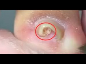 53K views · 573 reactions | How to cut extremely CURLED nails | Ingrown toenails | Facebook