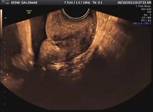 Measuring the Cervix with Vaginal Ultrasound