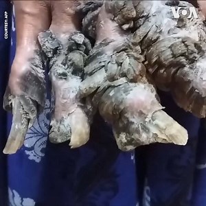 A 28-year-old father dubbed "Tree Man" for the wart-like growths on his body returned to the hospital on Sunday, Jan. 20, after his condition worsened. Abul Bajandar is suffering from Epidermodysplasia verruciformis, widely known as the “tree man syndrome." Bajandar went through 25 surgeries between 2016 and 2017 to remove the bark-like lesions from his hands and feet at Dhaka Medical College Hospital in Dhaka, Bangladesh. Doctors were on the verge of declaring their treatment a success before a