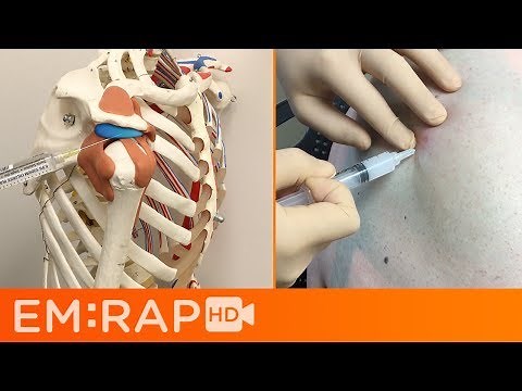 Subacromial Bursa Injection for Impingement Syndrome