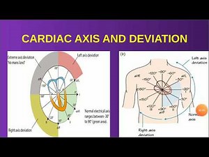CARDIAC AXIS AND AXIS DEVIATION EXPLAINED WITH ECG FINDINGS