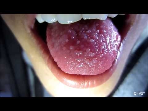 Papillitis Tongue