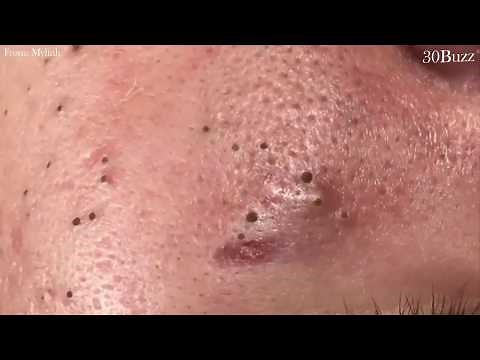 Top Blackheads Removal of The Month, Acne Treatment with Calm Music 2019