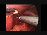 Laparoscopic Truncal Vagotomy and GJ • Video • MEDtube.net