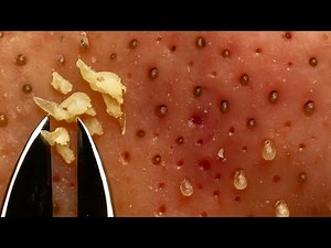 Extreme Nose Whitehead Plucking – Super Satisfying! #0002