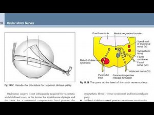 Kanski Clinical Ophthalmology - Neuro-ophthalmology "6th nerve palsy"
