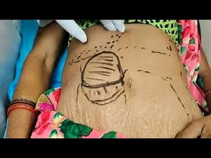 Abdominal Lump - Surgical Clinics with Prof. Chintamani