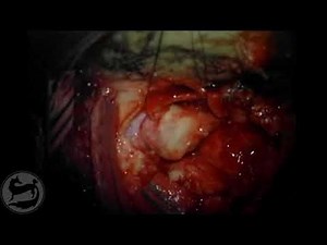 Video C2 Schwannoma Resection Youmans and Winn Neurological Surgery