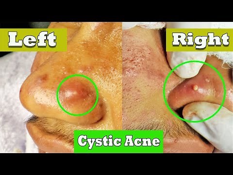 Drainage de l'acné kystique sur le nez | cystic acne extraction