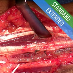 Flexor Digitorum Profundus Tenodesis (Median FDP to Ulnar FDP)