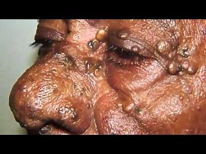 Solar Comedones Extraction Skincare News