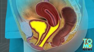 Sex toy stuck in vagina for 10 years | Ethnic Health Court - English