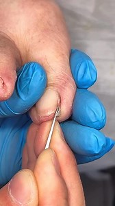 9.7K views · 56 reactions | Prevent Fungal Infections with Correct Nail Cutting Techniques | ADN Medical | Facebook