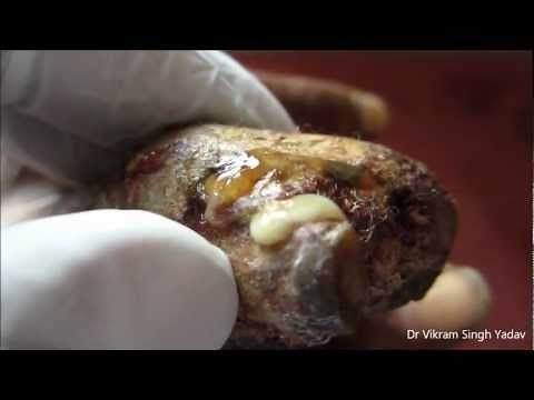 Infected Wound Of Finger