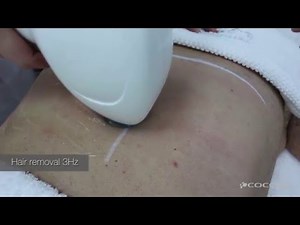 Hair removal with diode laser elysion | cocoon medical